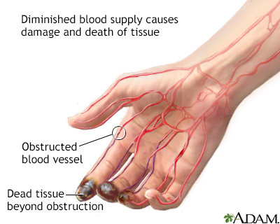 Thromboangiites obliterans